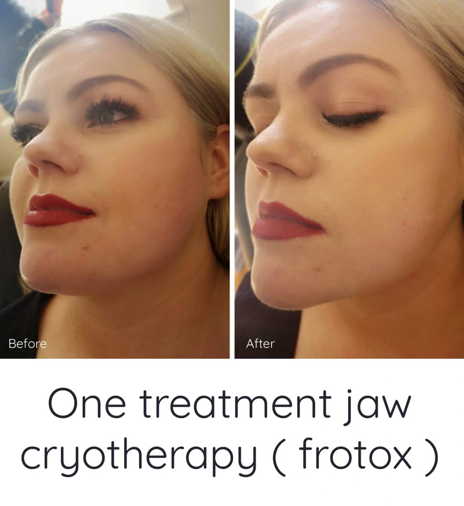 Jaw Cryotherapy