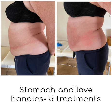 Stomach and love handles cryotherapy