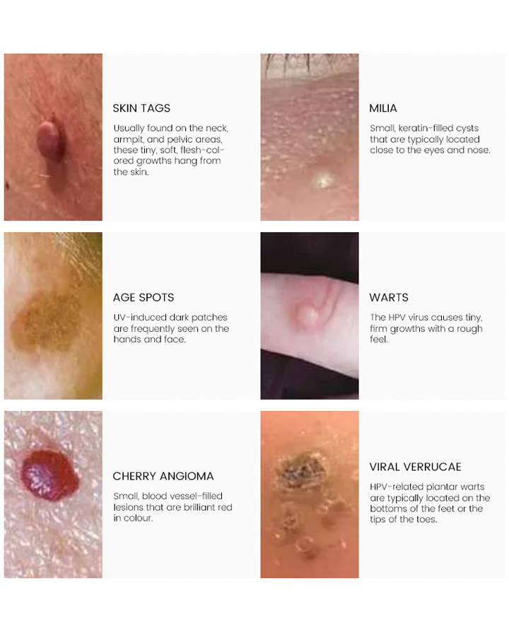 Cryotherapy Skin Lesion Removal - Treatments by Joanna