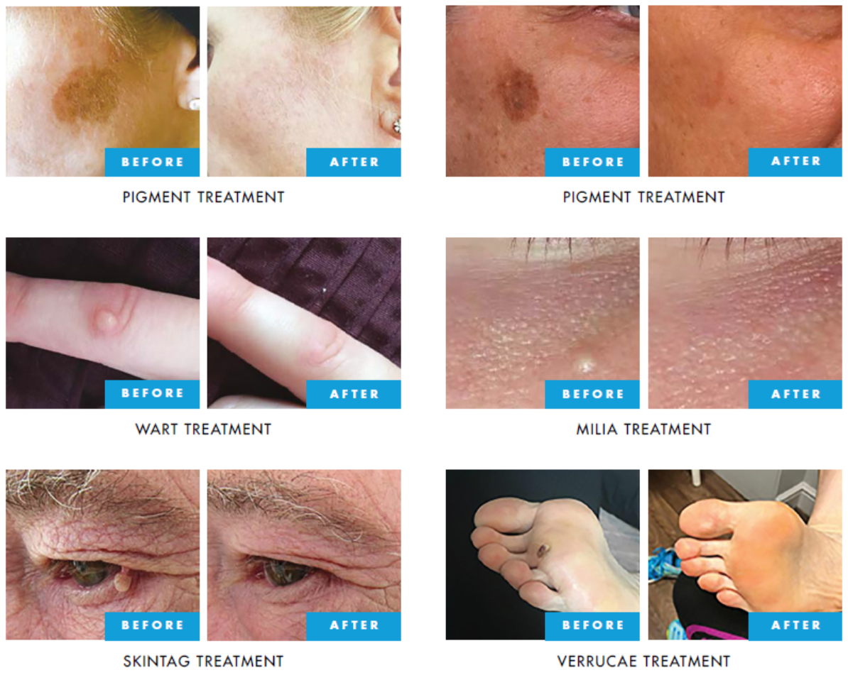cryo skin lesions removal b