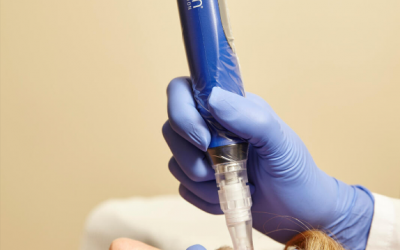 SkinPen Microneedling: What It Is, How It Works and What to Expect